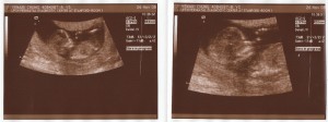 Third Ultrasound